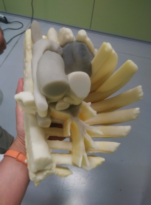 Andaltec fabrica un modelo 3D para facilitar la operación del tumor en el pecho de una niña